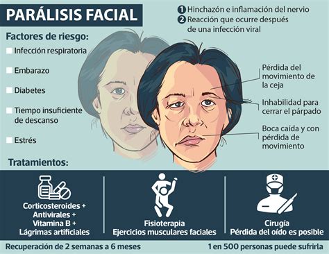 parálisis de Bell biopoder de la expresión facial