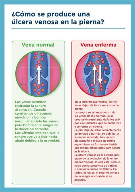 circulation venosa y factores de riesgo