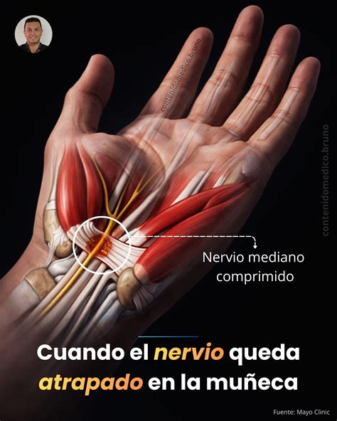 Ilustración de deslizamiento del nervio mediano en la muñeca