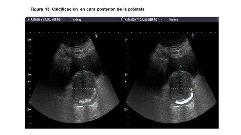 gráfica de suelo pélvico y próstata