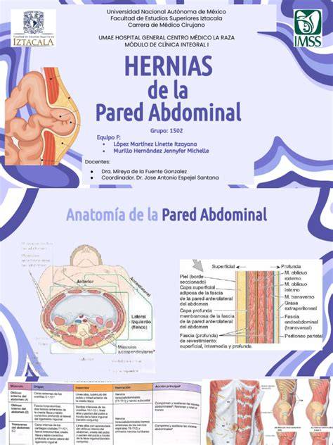 infografía de anatomía de la pared abdominal y hernia inguinal