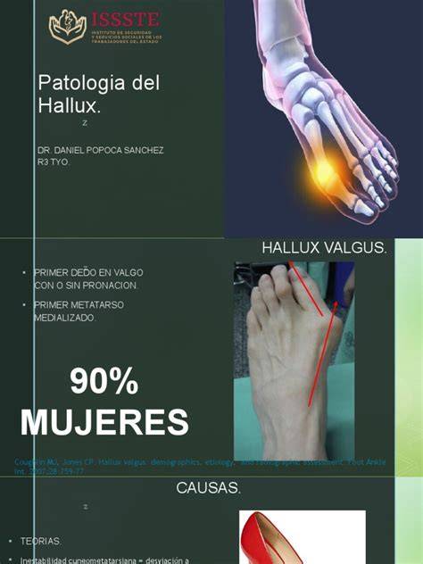 Mapa de causas y tratamiento del hallux valgus