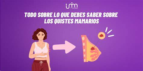infografico sobre quistes mamarios